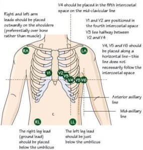 How to perform a 12 lead ECG/EKG - meditechtips.com