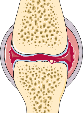 Abatacept