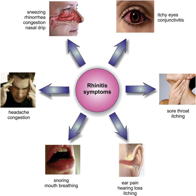 Allergic rhinitis 1