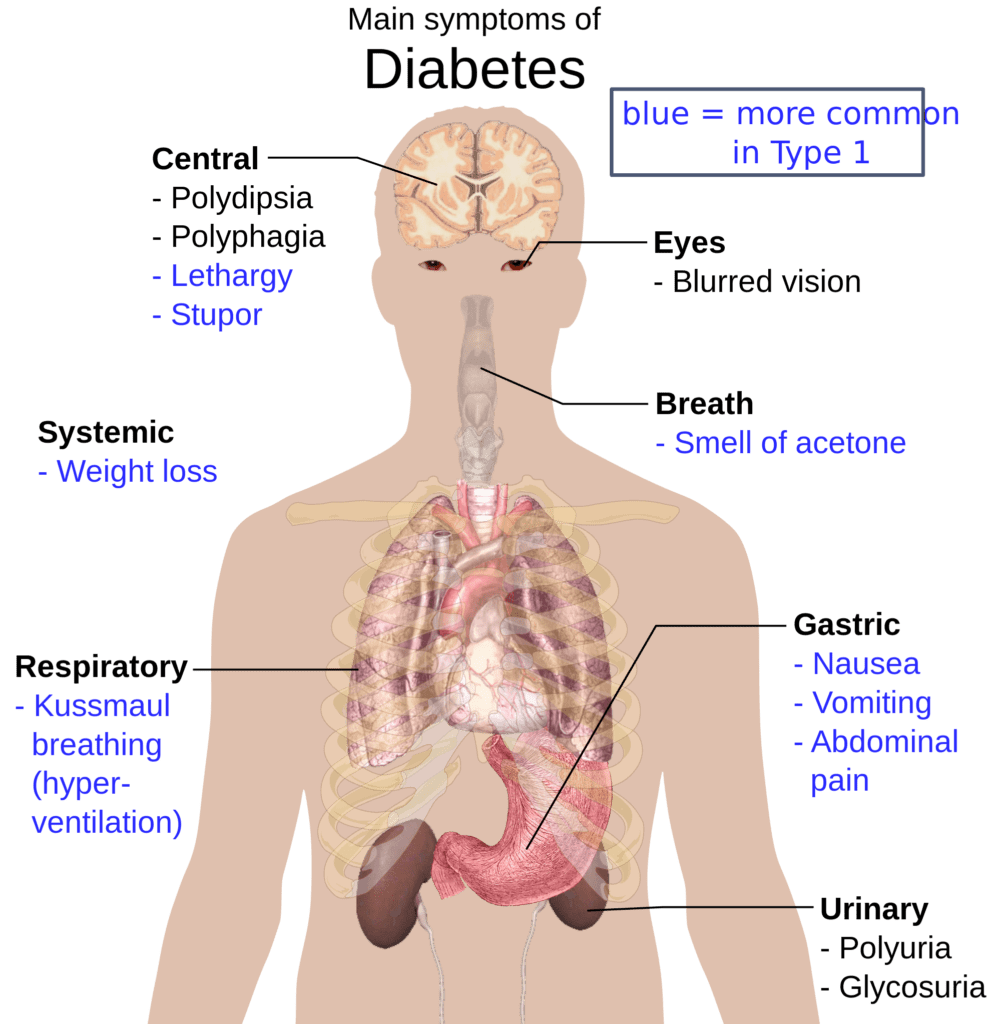 Symptom of Diabetes mellitus